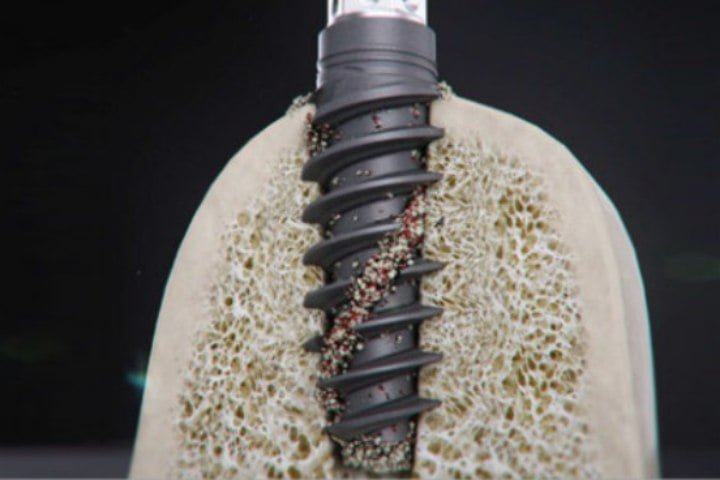 imagem demonstrando como é o processo de osseointegração nos implantes