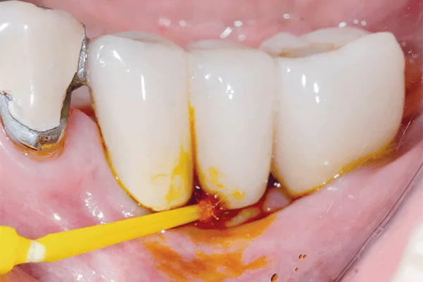 aplicação de remédio a peri-implantite - imagem de dentes reais