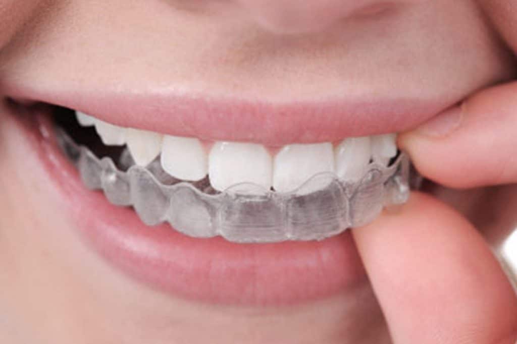 Mulher colocando sua placa de bruxismo de silicone