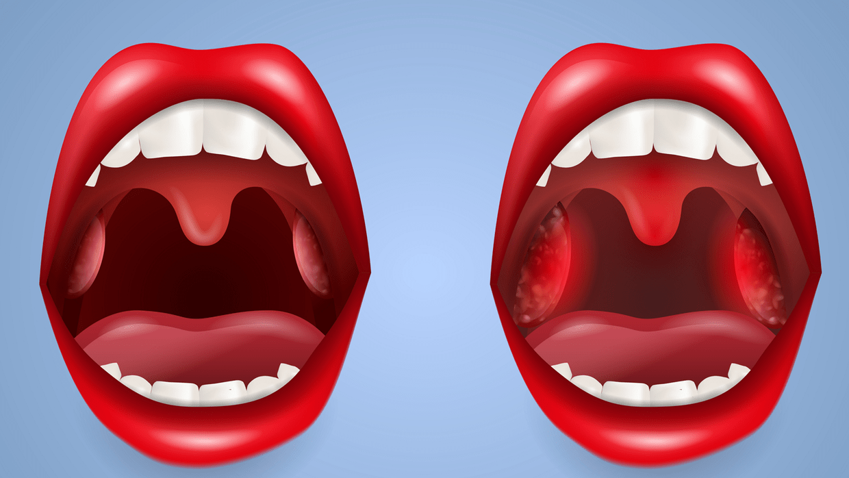 Desenho de duas bocas abertas. A primeira é uma boca normal. Já a segunda mostra uma inflamação nas amigdálas.