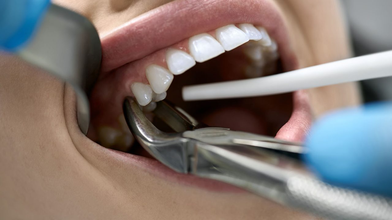 Dentista fazendo extração de dente de paciente com alicate