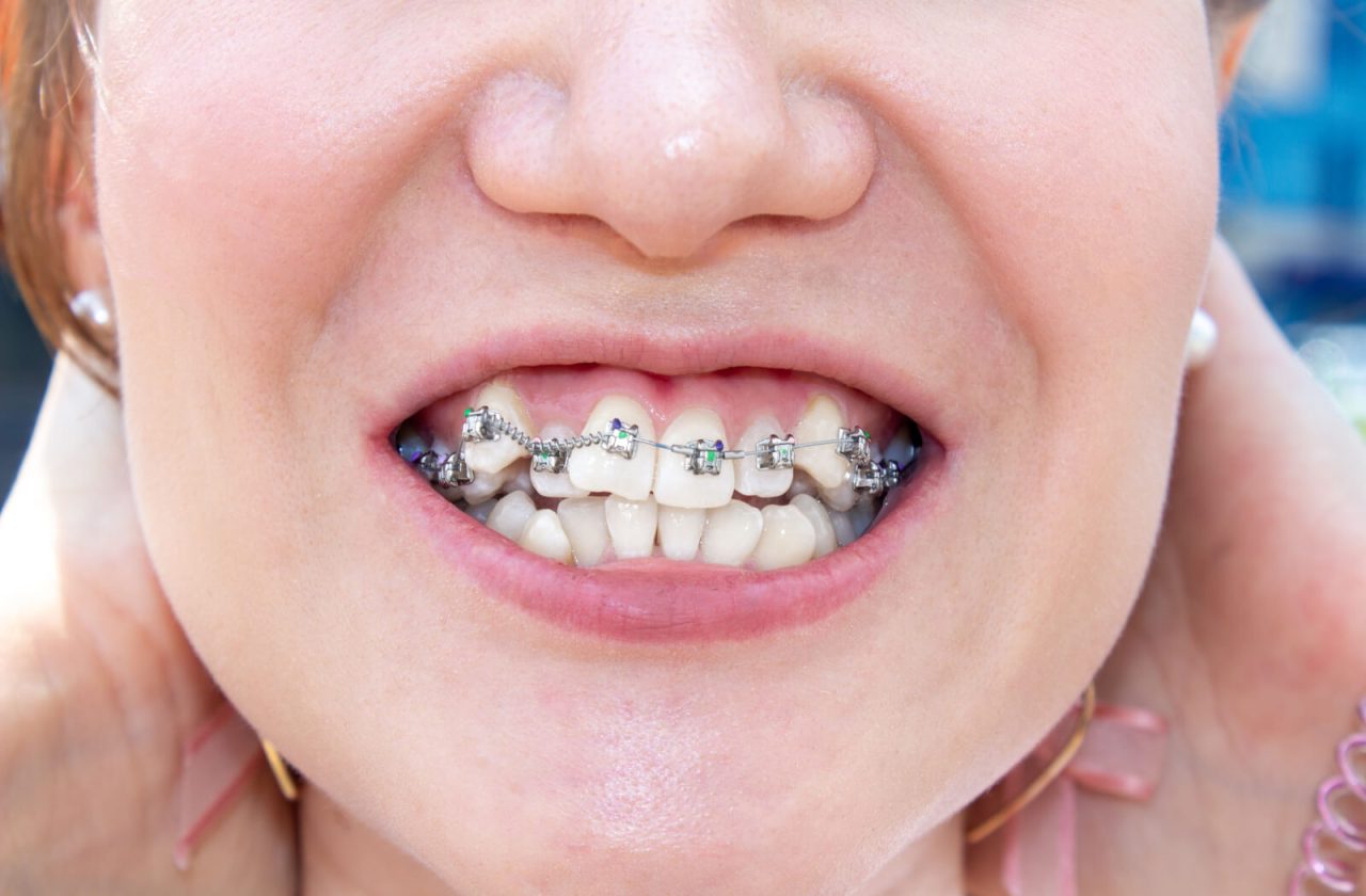 Mulher com dentes encavalados está usando aparelho ortodôntico