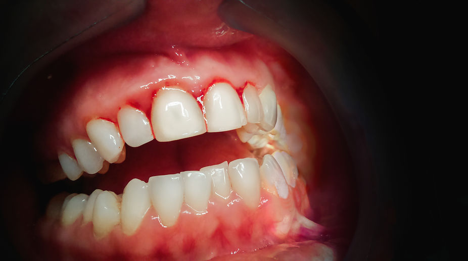 Quais as causas da perda de dentes em idosos?