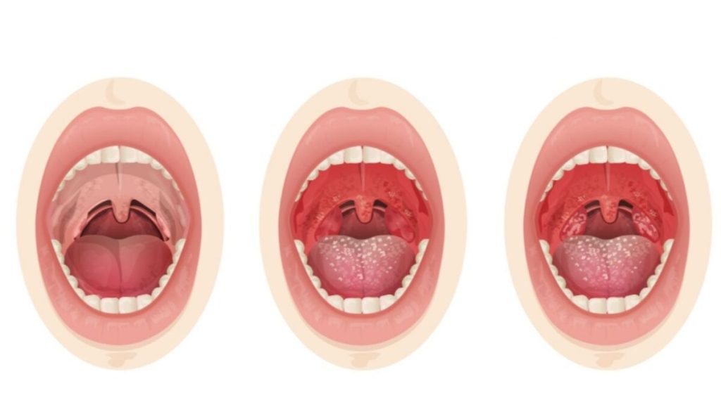 Imagem em desenho mostra evolução de amigdalite.