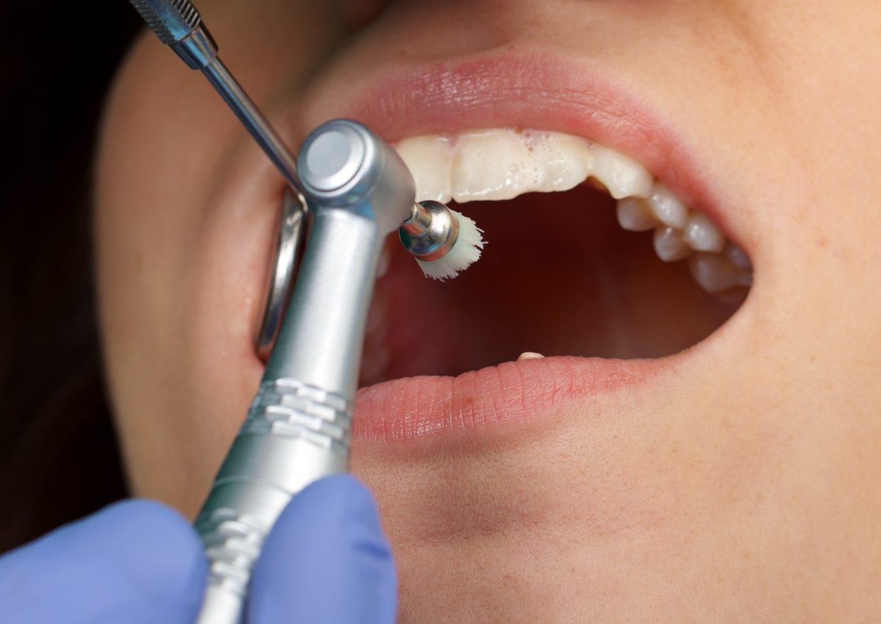 Dentista realizando limpeza em dente de paciente.
