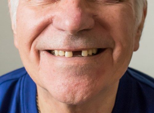 Idoso de camiseta azul-escuro está sorrindo. Falta um dente na frente.