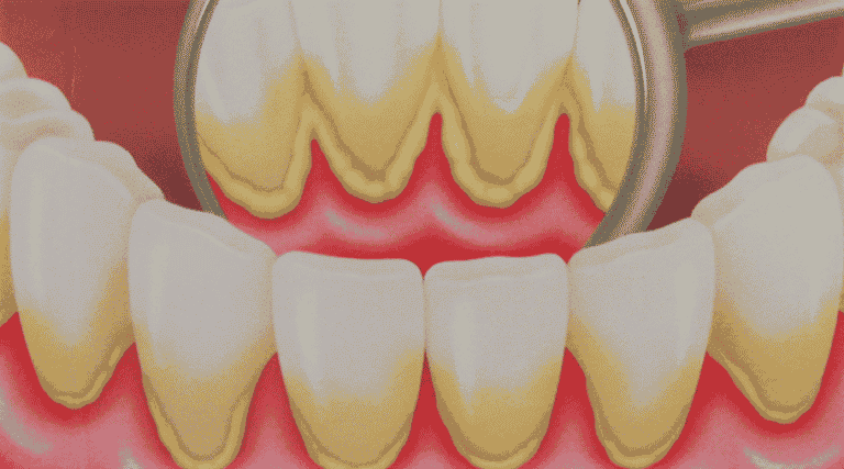 Desenho de dentes com placa bacteriana e tártaro