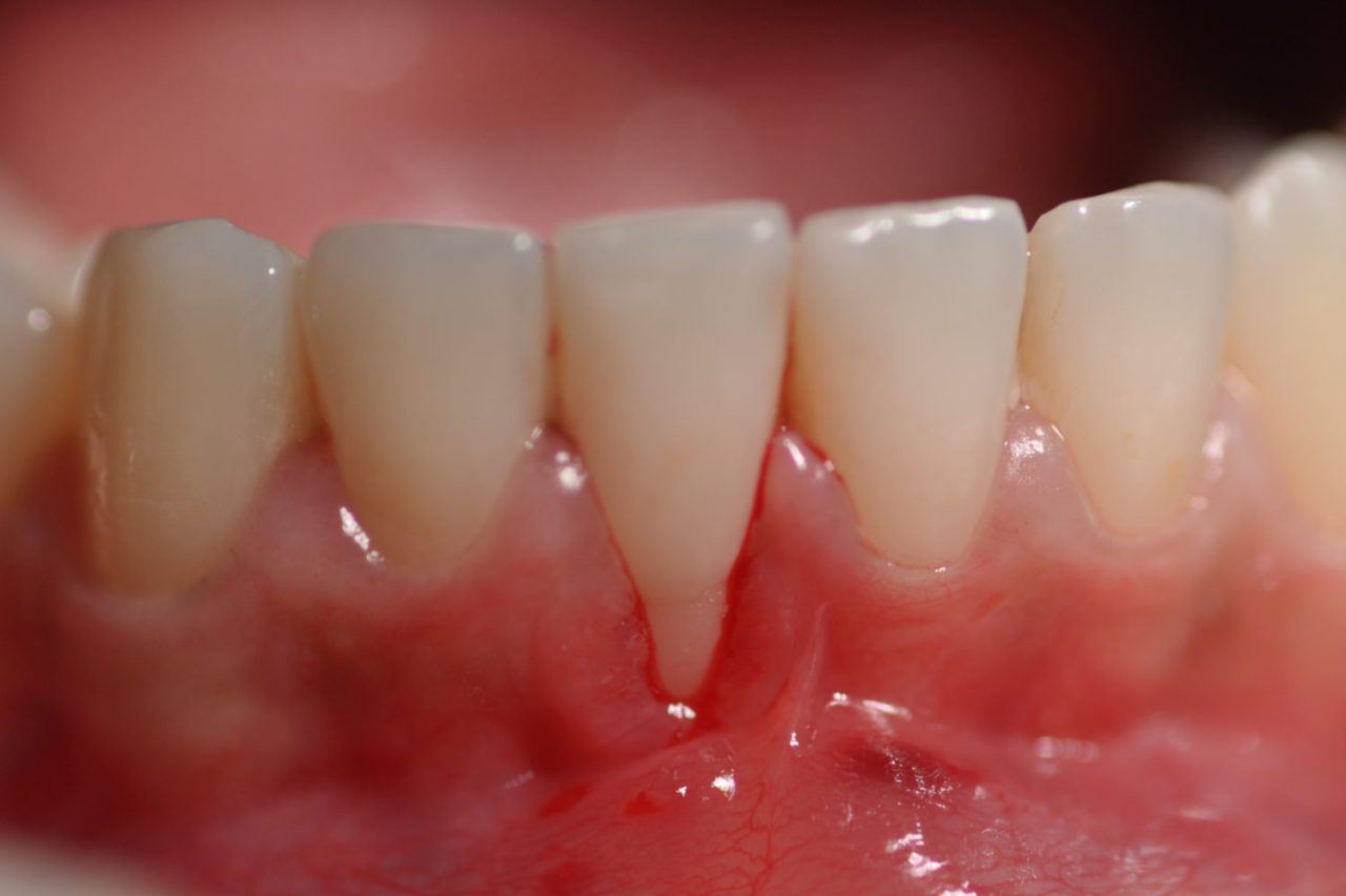 Raiz do dente está exposta e inflamada.
