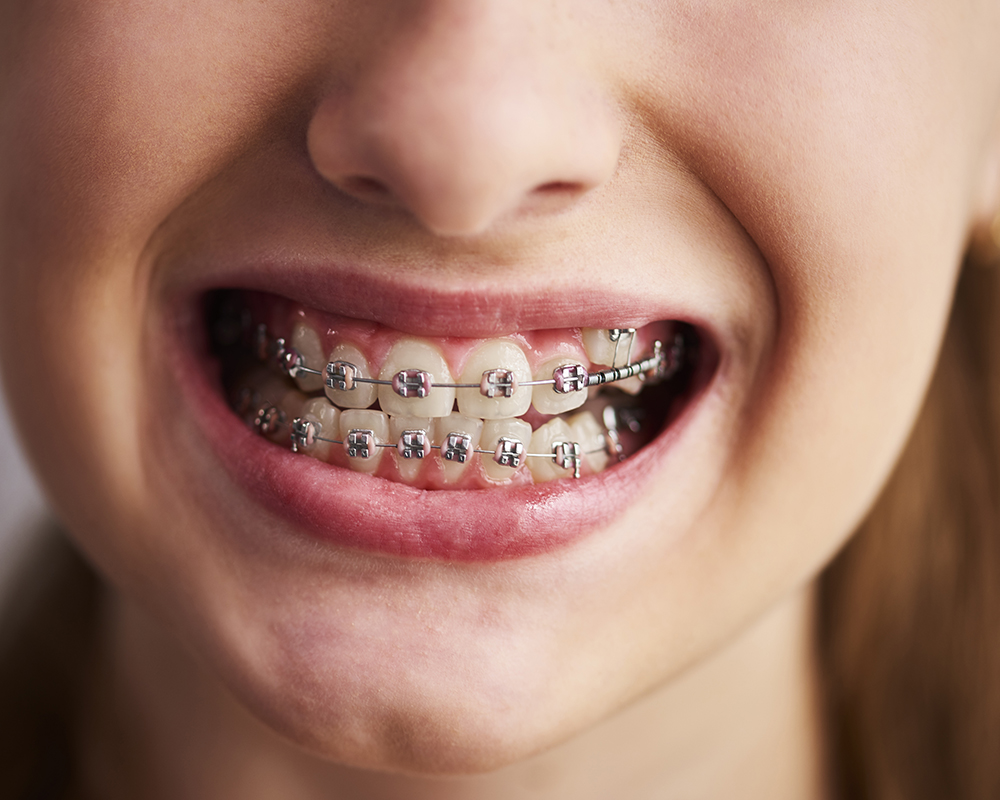 Mulher sorrindo mostrando seu aparelho ortodôntico