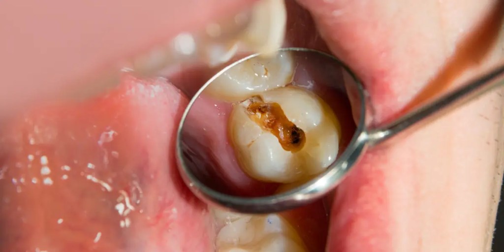 Imagem mostra uma cárie profunda refletida no espelhinho de dentista.