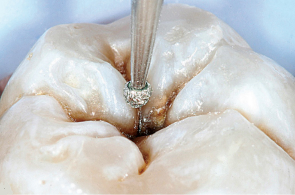 imagem mostra zoom em obturação de dente com cárie