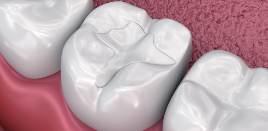 Imagem criada digitalmente mostra dente após curetagem pulpar