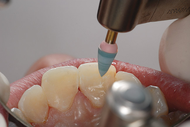 Moldando o dente após ter colocado a resina.