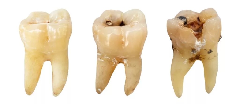 Evolução de dente normal para dente com cárie.