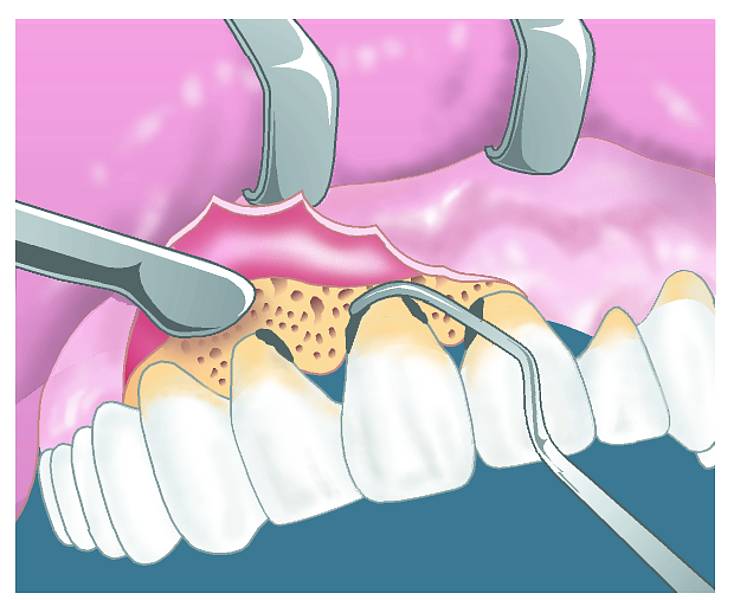Desenho mostra cirurgia dentária em que levanta a gengiva