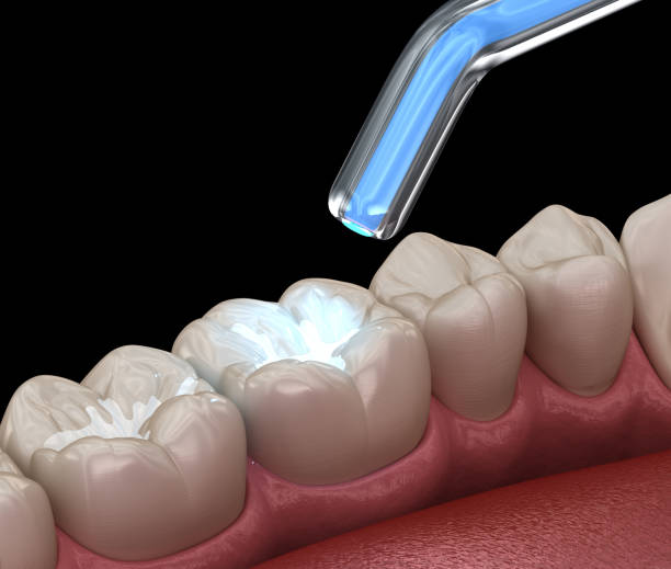Imagem feita digitalmente de dentes com resina composta. Está se colocando uma luz sob os dentes para secar a resina.