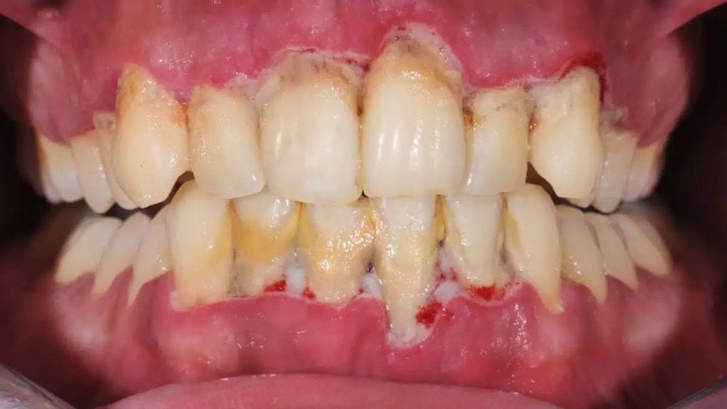 boca de pessoa com periodontite