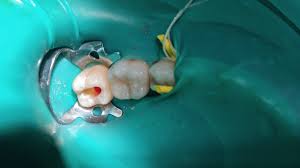 Realizando pulpotomia em dente que está isolado