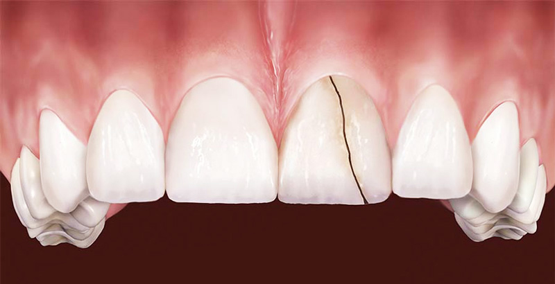 Imagem digital de dente da frente rachado