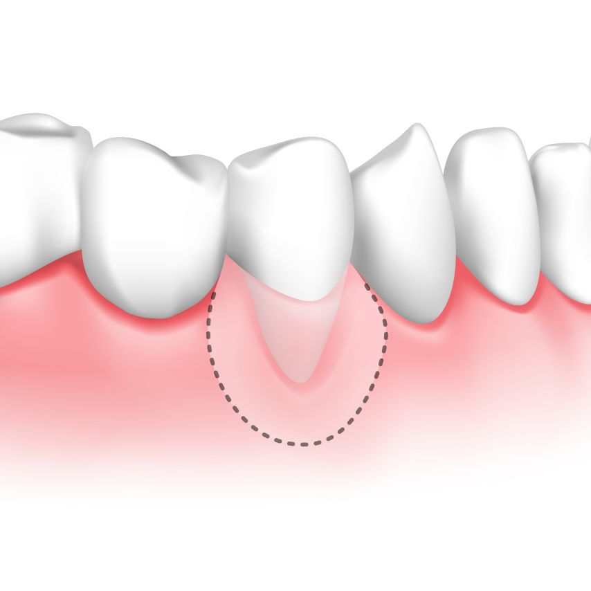 Desenho feito digitalmente da arcada dentária inferior. Na gengiva tem desenhado um circulado pontilhado onde fica a raiz do dente.