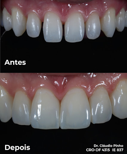 Antes e depois usando resina composta