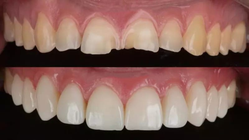 Antes e depois de reparo em dentes que estavam quebrados na frente com resina composta.
