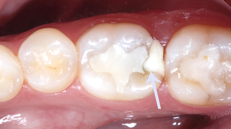 Seta apontando para onde foi feita uma restauração onde houve uma infiltração no dente