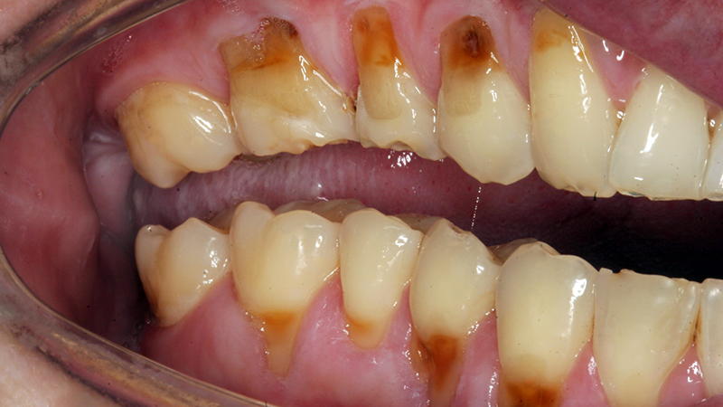 Boca com vários dentes com raiz expostas e amareladas, escurecidas.