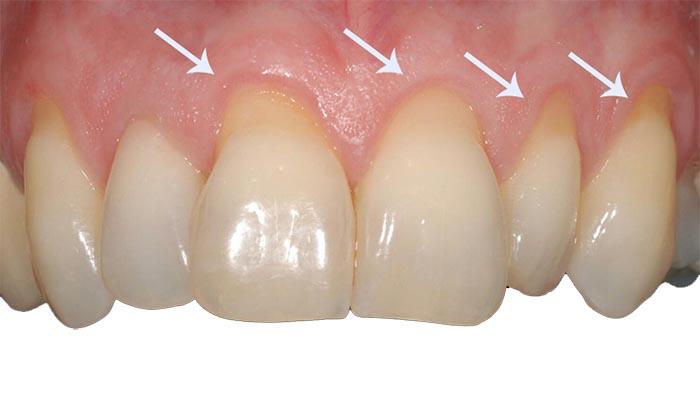 Imagem de boca com retração gengival e setas apontando onde a raiz está exposta