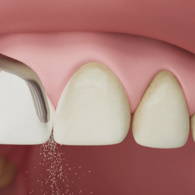 Vídeo mostrando a limpeza do jato de bicarbonato.