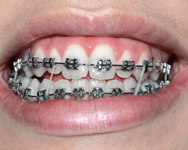 Imagem focada em boca de paciente que tem elástico ortodôntico em forma de caixa