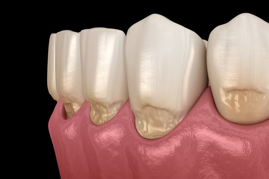 Dentes com lesão cervical não cariosa do tipo abfração