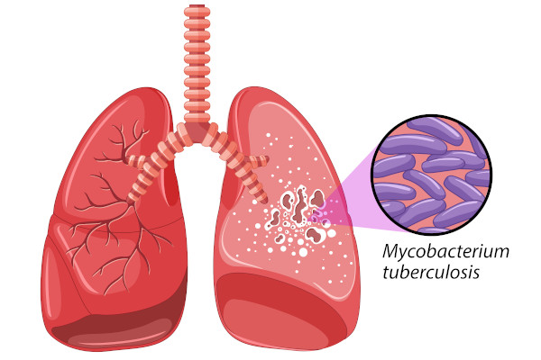 Desenho de pulmão com tuberculose.