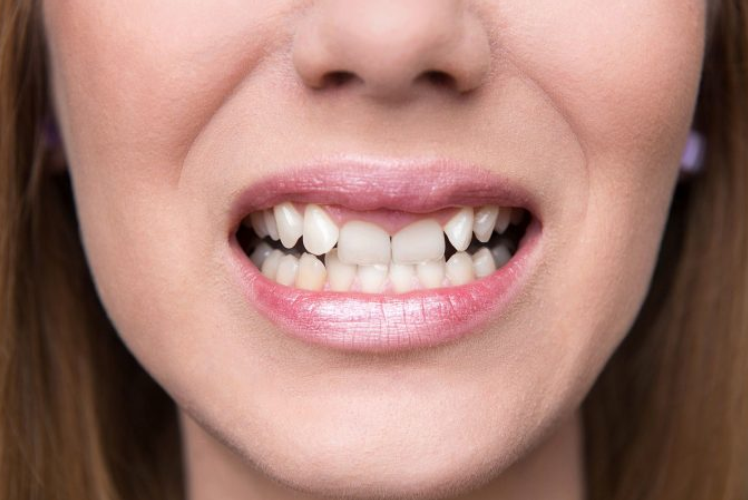 Mulher está sorrindo e mostrando seus dentes que são apinhados.