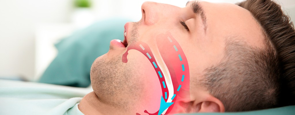 Homem roncando enquanto dorme, tem desenho na imagem mostrando como a respiração dele está errada.