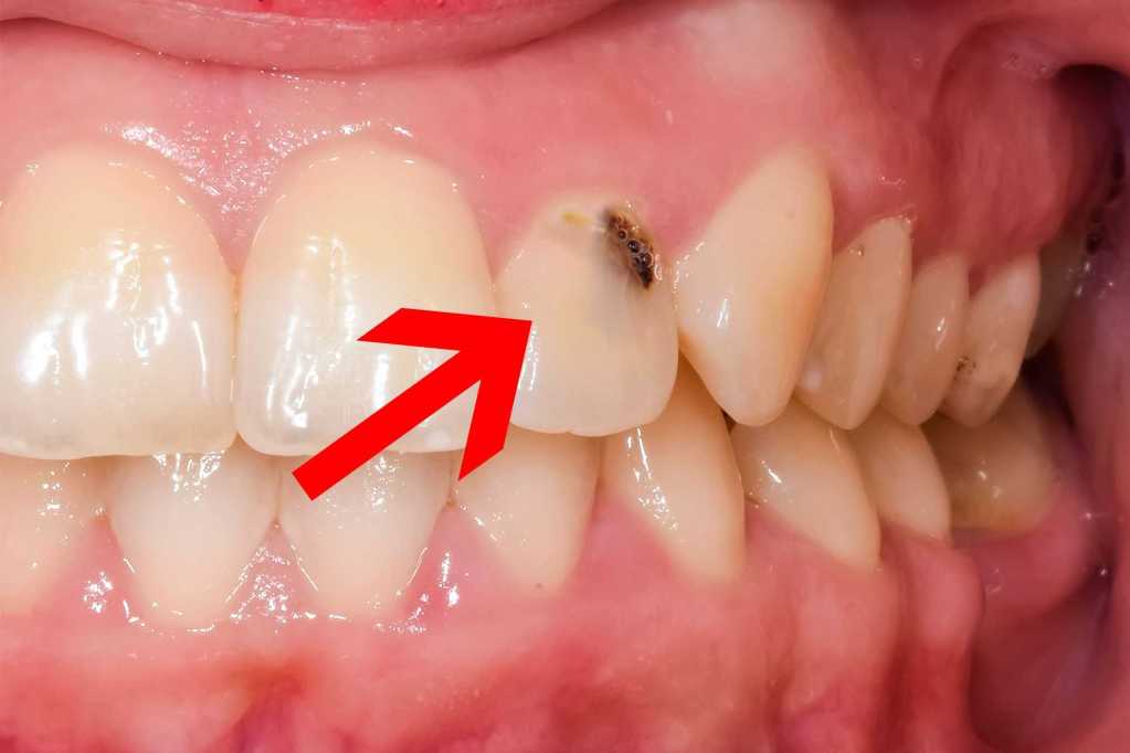 Seta apontando cárie em dente