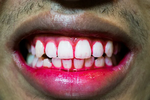 Boca de homem está sangrando devido a escorbuto.