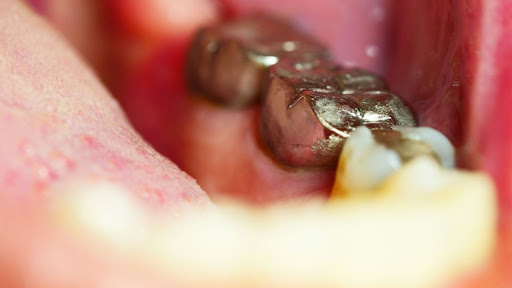coroas dentárias de metal na boca do paciente