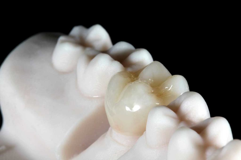 coroa de resina em meio a molde