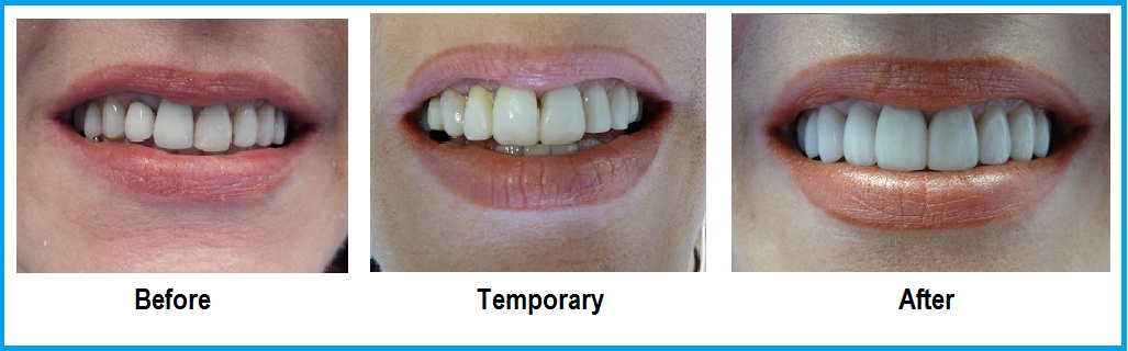 boca de mulher antes do tratamento, durante usando o provisório, e o depois já com as coroas definitivas