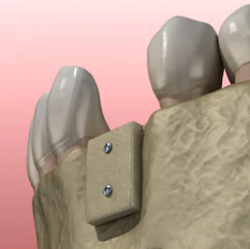 imagem criada digitalmente mostra como ficaria a gengiva após enxerto