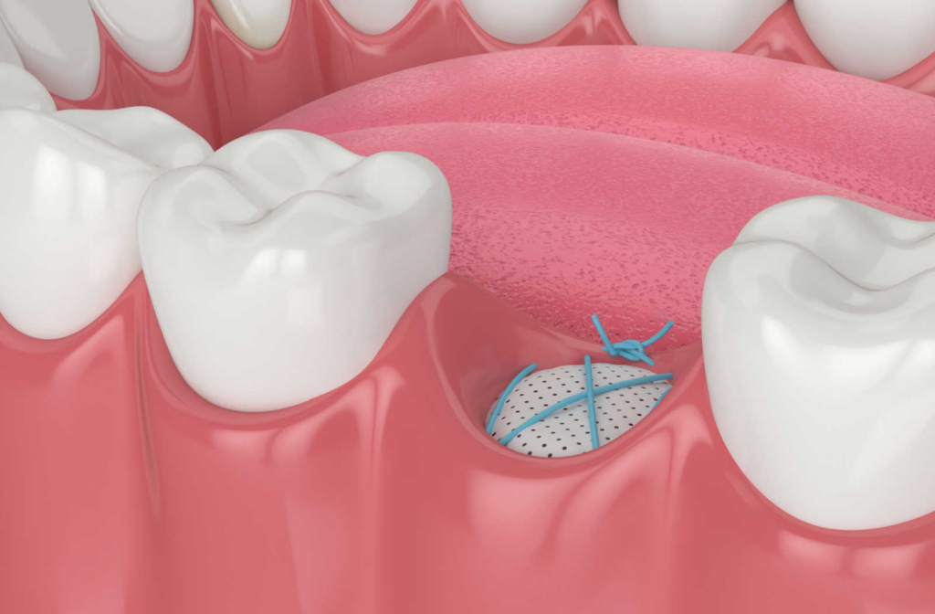 imagem digital de gengiva com enxerto ósseo e costura por cima