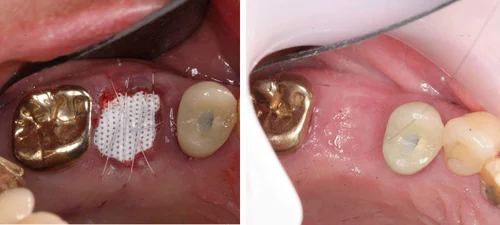 Imagem mostra antes e depois de enxerto ósseo