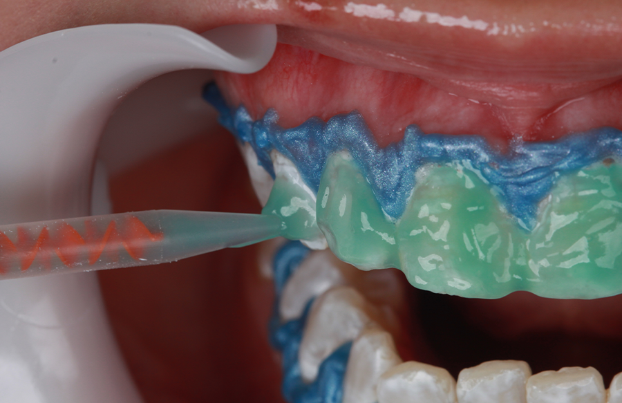 aplicando produto de clareamento nos dentes
