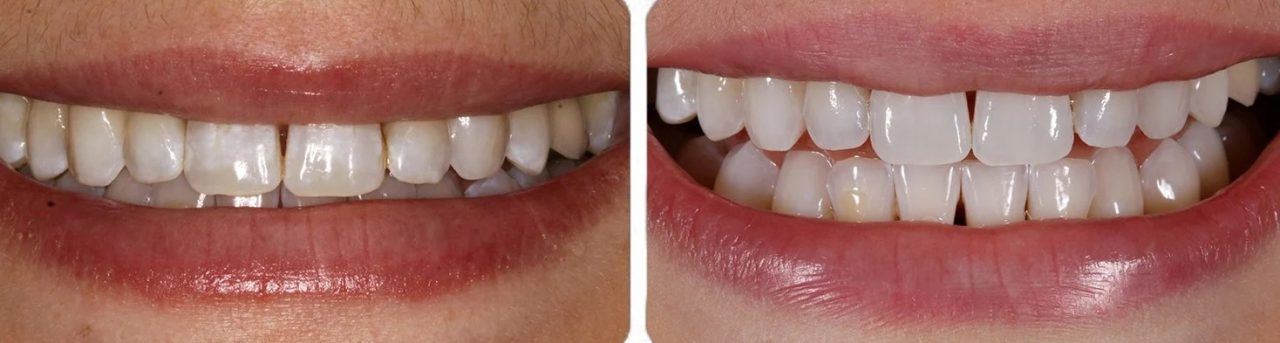 antes e depois de procedimento microabrasão dental
