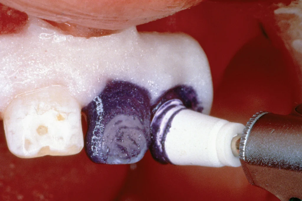 Utilizando escova rotatória em produto de microabrasão dental no dente do paciente.