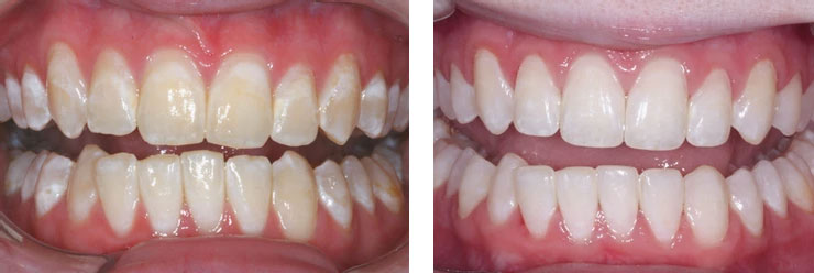antes e depois de procedimento microabrasão dental