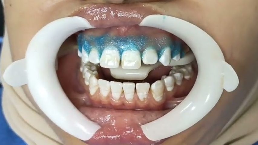 Paciente usando afastador odontológico enquanto produto de microabasão age no esmalte do dente
