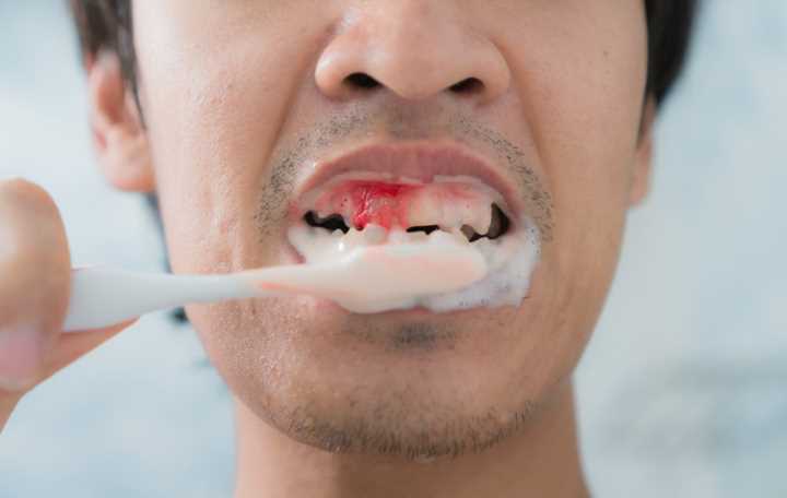 homem escovando os dentes, enquanto sua gengiva está sangrando