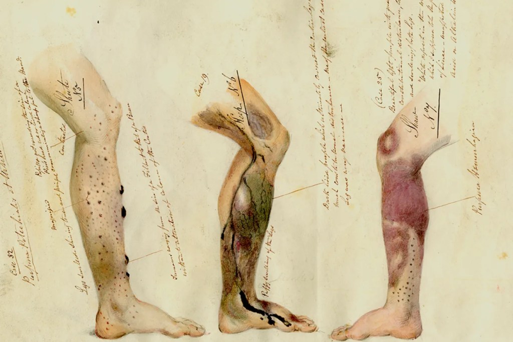 Desenhos parecem ter saído de um livro mostram consequências graves na perna em pessoa com escorbuto.